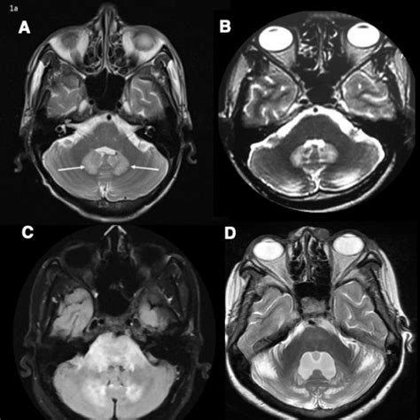 Imaging of Dentate Nucleus Pathologies: A Case Series - Journal of ...