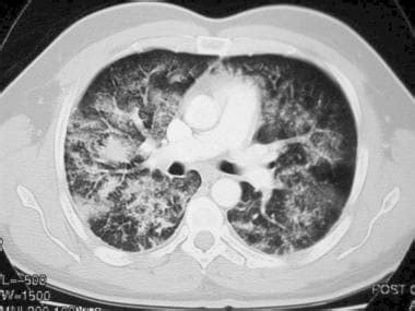 Noncardiogenic Pulmonary Edema