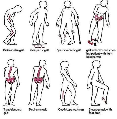 Types of gait | Physical therapy student, Physical therapy assistant ...