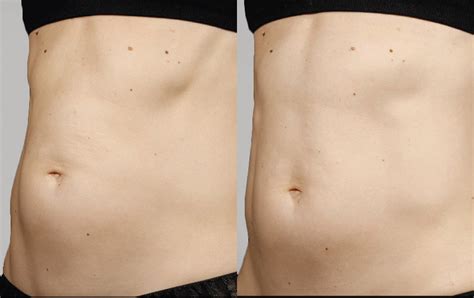 SculpSure | Before & After Photos | LightRx Face & Body