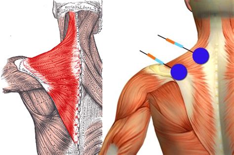 Trapezitis | Trapezius | Physiotherapeutic | Therapy | Wet Heat ...