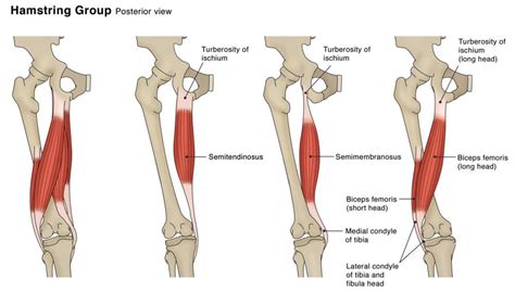 Hamstring strain