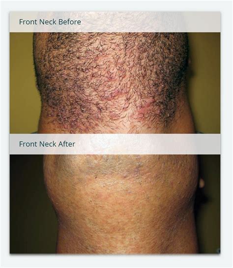 Before & After Photos of Laser Hair Removal | Milan Laser Ingrown Hair ...