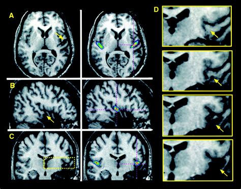 Auditory Cortex Mri