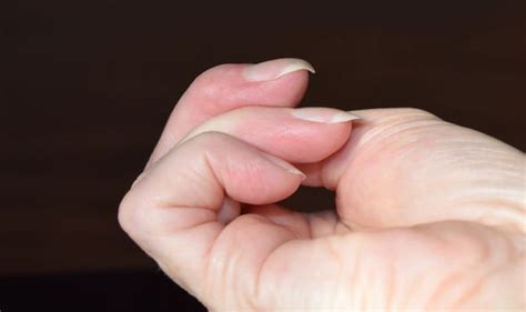 Lung cancer symptoms: Curved nails could be a warning sign of the ...