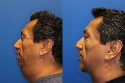 Neck Lift Before & After Photo Gallery | San Francisco, CA | Kaiser ...