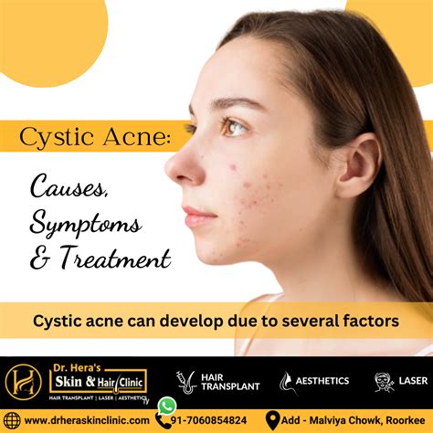 Cystic Acne: Causes, Symptoms And Treatment - Dermatologist in Roorkee