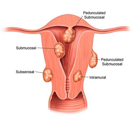 Evaluating Uterine Fibroid Size for Removal | UFE