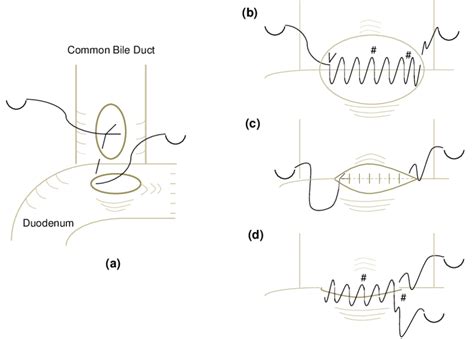 Illustration of the laparoscopic choledochoduodenostomy. (a) Initial ...