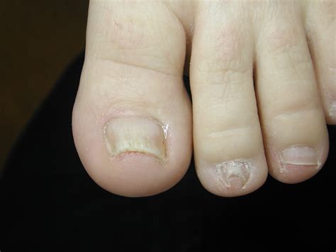 Ingrowing toenail correction with surgery & bracing | Foot Fix Clinic