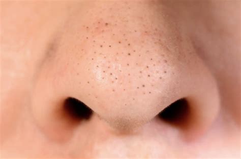 What are Blackheads and How To Treat Them? - My Cozy Room