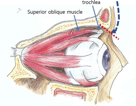 Sagittal view of extraocular muscles in right orbit. The range of ...