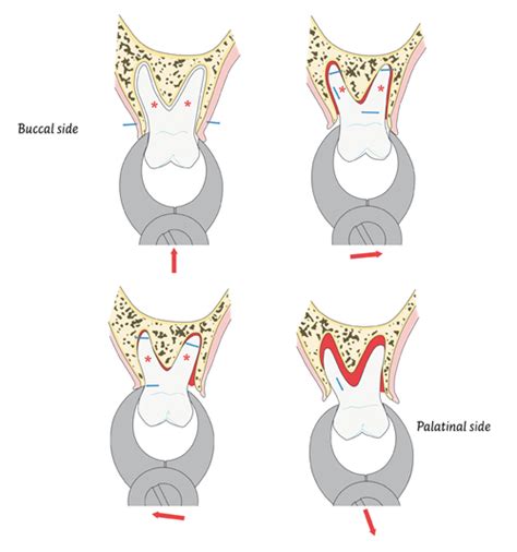 Extraction of maxillary molars