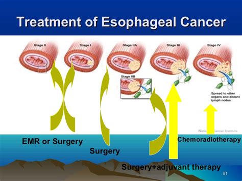 Esophageal Cancer