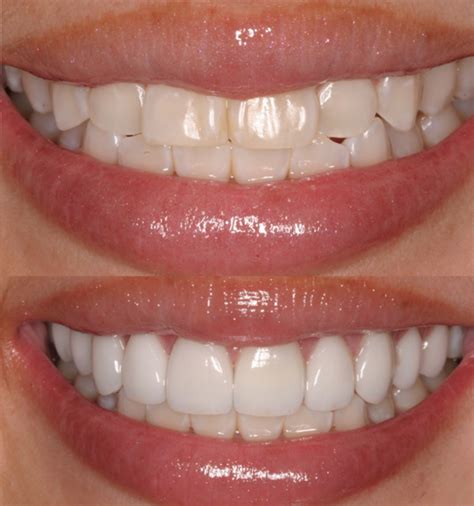 Veneers- The Modern and Convenient Way to Enhance Your Smile | Dentist ...