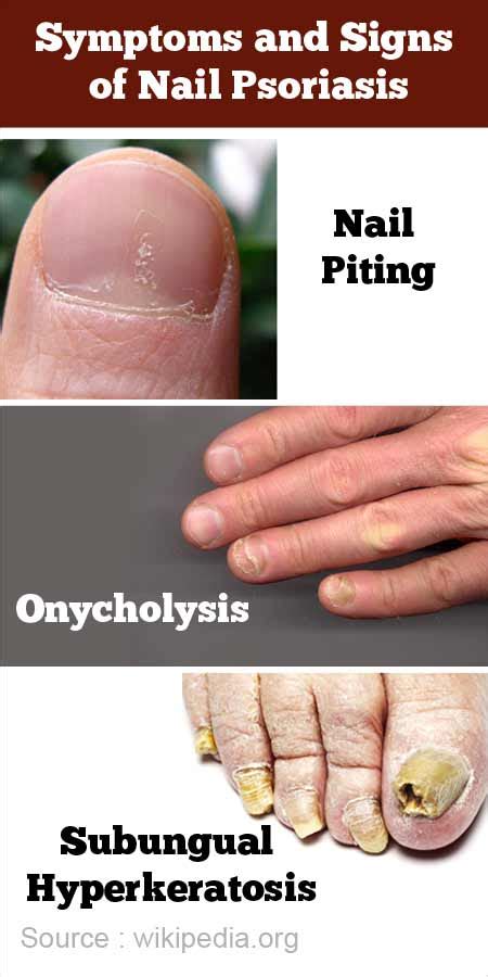 Onycholysis Psoriasis