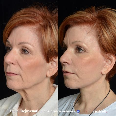 12 Facelift Recovery Tips to Know | Facelift recovery, Face lift ...