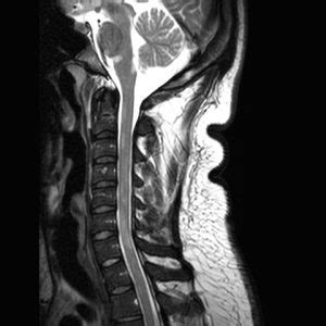 Diagnosing Multiple Sclerosis With MRI | AffordableMRI.com