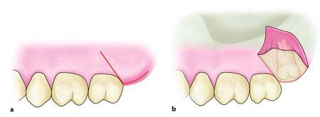 Type of Incisons and Flaps used in Impaction of Maxillary 3rd Molar