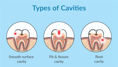 Smooth Surface Cavities - My Dentist Burbank