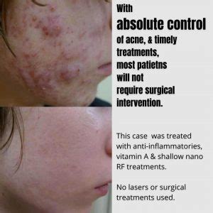 Best Cystic Acne Treatments In Australia | Dr Davin Lim