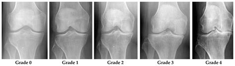 Osteoarthritis Knee