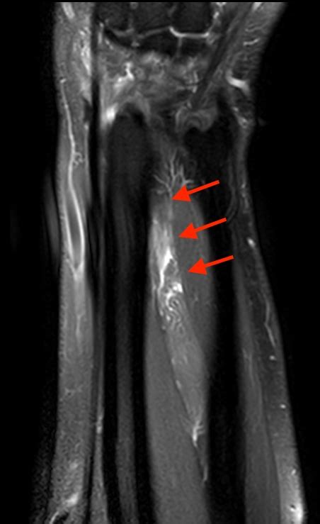 Extensor Pollicis Longus Mri