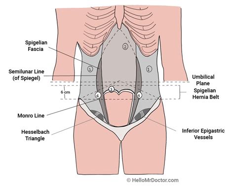 Spigelian Hernia - Pictures, Location, Causes, Treatment