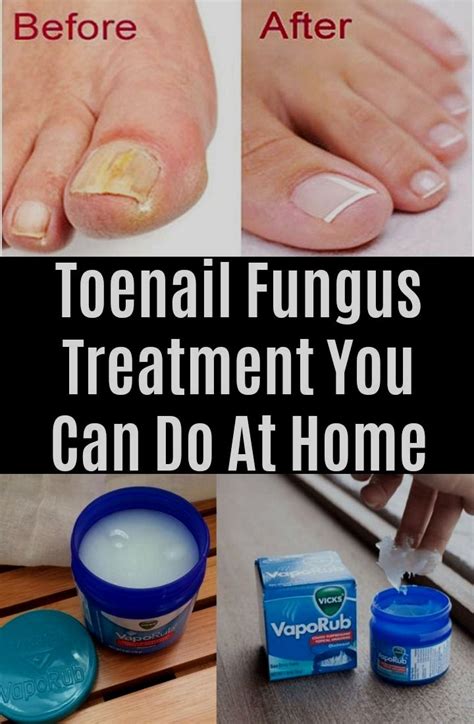 Toenail Fungus Remedies, Toenail Fungus Treatment, Bloating Remedies ...