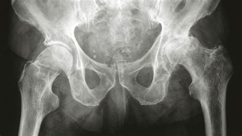 Osteoarthritis Hip X-Ray: Findings, Staging, and More