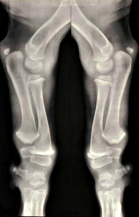 Treatment Found for Brittle Bone Disease