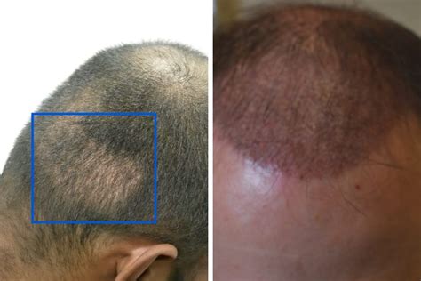 Hair Transplant After 1 Month: Photos, Results, Side Effects