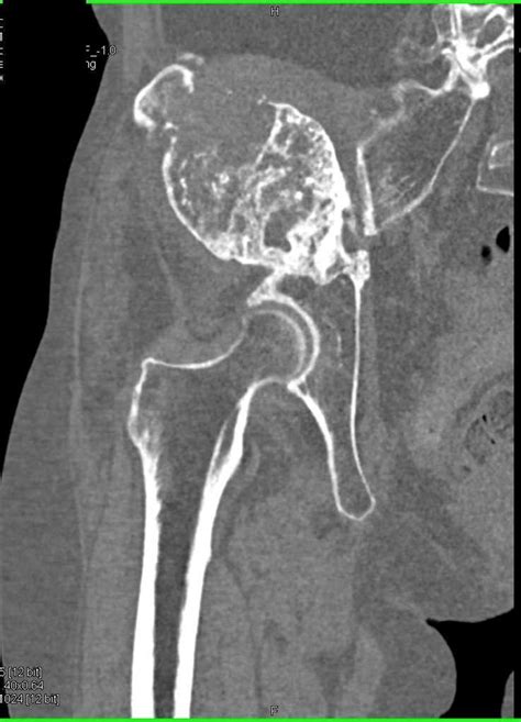 Malignant Giant Cell Tumor Right Iliac Wing / CTisus.com | Case study ...