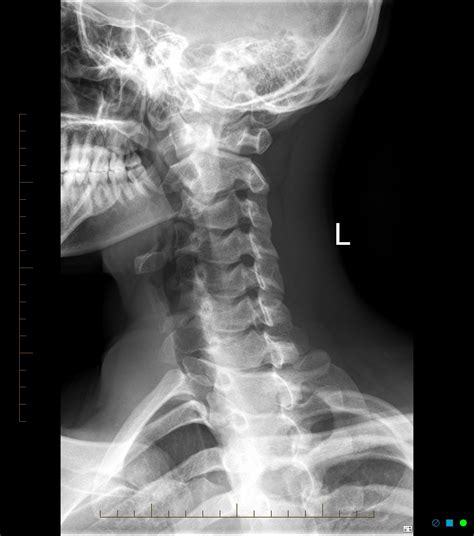 NORMAL CERVICAL SPINE | Buyxraysonline