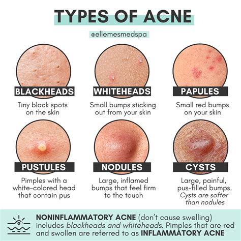 i have like cysts please what can be the solution : r/AusSkincare ...