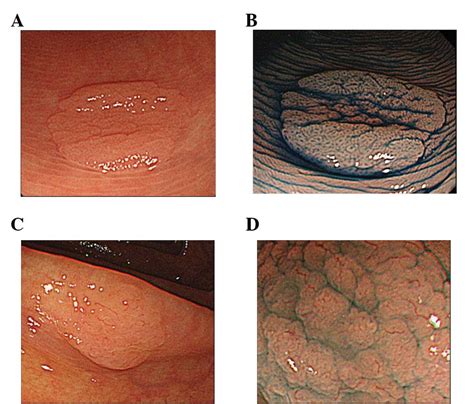 What is a sessile polyp? - powerpointban.web.fc2.com