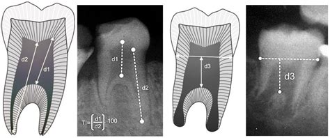 Taurodontism: from Neanderthals till modern human population | Semantic ...