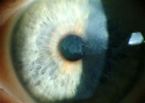 Salzmann's Nodular Corneal Degeneration: The University of Iowa ...