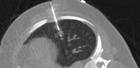 7.8 mm lung nodule biopsy