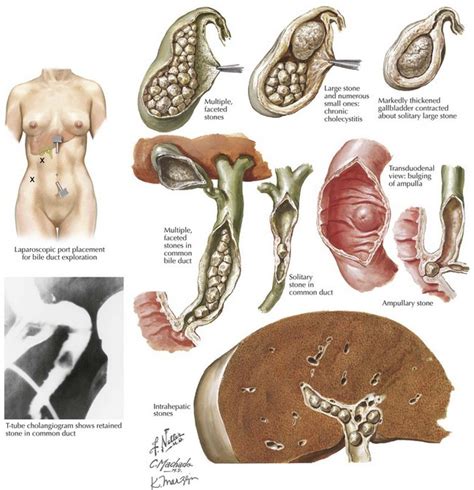 Common Bile Duct Surgery and Choledochoduodenostomy | Basicmedical Key