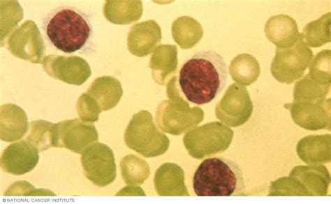 Hairy cell leukemia - Diagnosis and treatment - Mayo Clinic