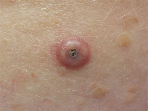 Squamous Cell Carcinoma - Pennsylvania Dermatology Specialists