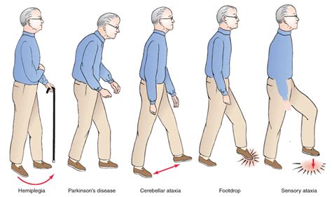 Neuro Exam: Post-Stroke Hemiplegic Gait – StrokeSciences