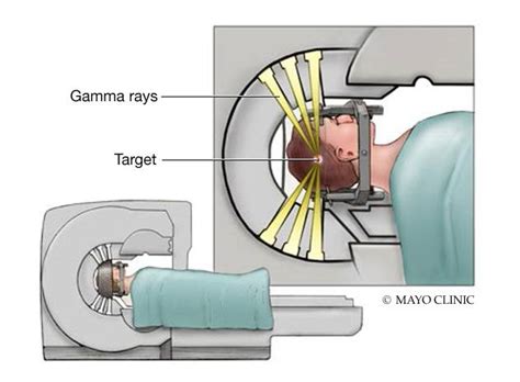 Advancements in gamma knife radio surgery - Mayo Clinic News Network