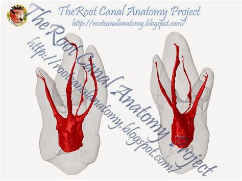 The Root Canal Anatomy Project: Maxillary First Molar: MB2