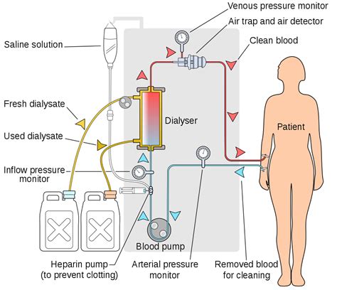 All about (hemo)dialysis – kidney4karen