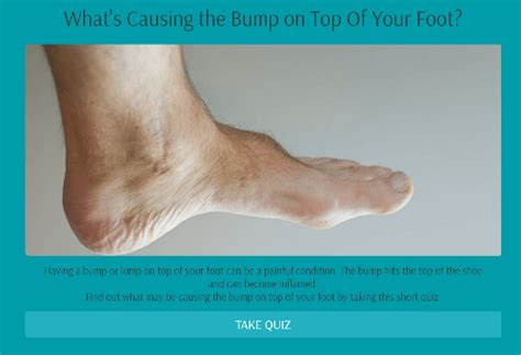 Painful Bump On The Ball Of My Foot Hotsell | emergencydentistry.com