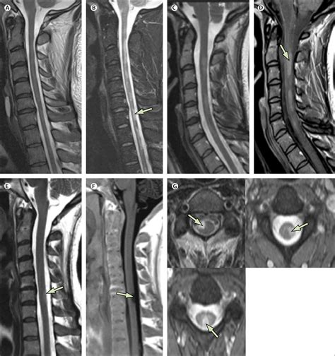 Cervical Spine Mri Ms