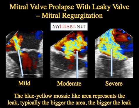 Mitral Regurgitation & Mitral Valve Prolapse