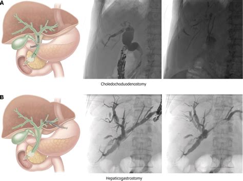 Schematic and case illustration of the choledochoduodenostomy (A) and ...